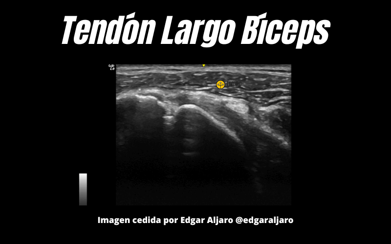 8. Tendon Largo Biceps Ecografia Tempo Formacion.png